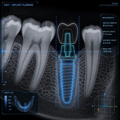 Digitale implantaatplanning op een CBCT-opname, met metingen van het implantaat